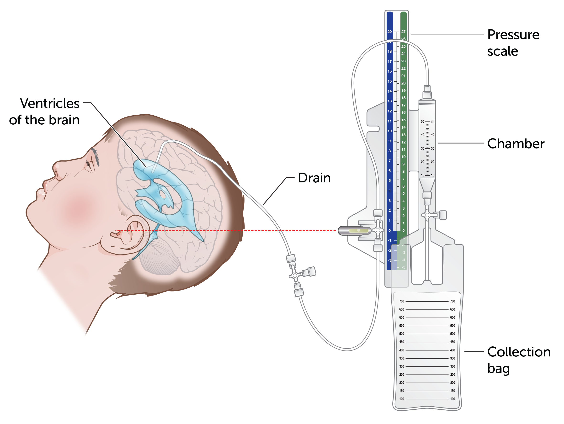 External ventricular drain